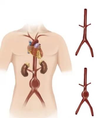 Modelo anatômico de aneurisma da aorta abdominal - 021 series