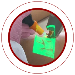 Laser transdermico para vasinhos de perna e face